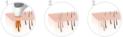 TriaBeauty-HLR4X-12